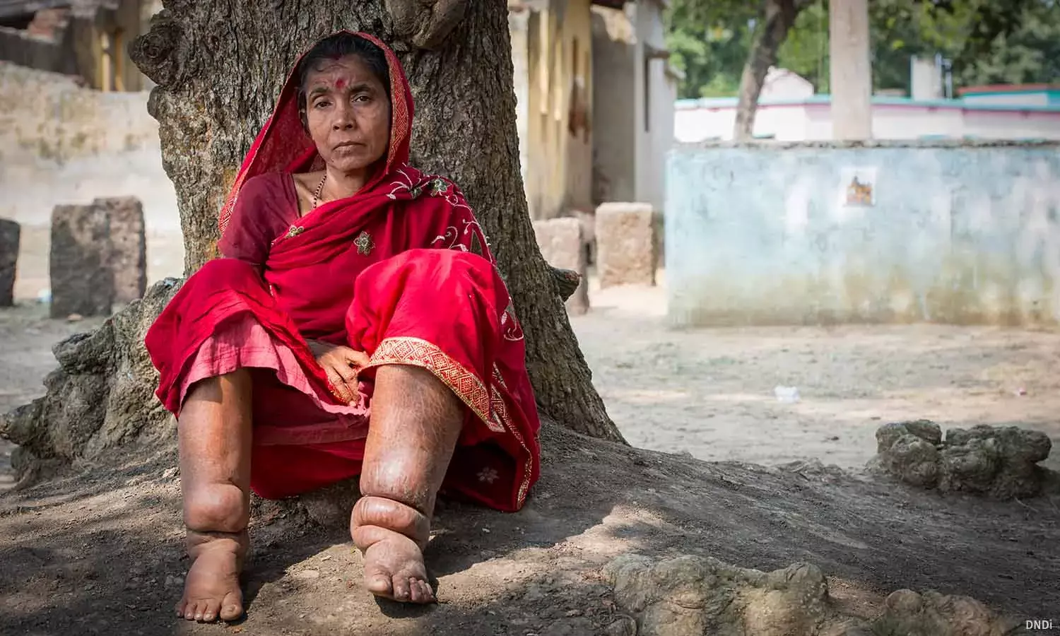 Elimination by 2027? India’s Final Push Against Lymphatic Filariasis Elimination by 2027? India’s Final Push Against Lymphatic Filariasis