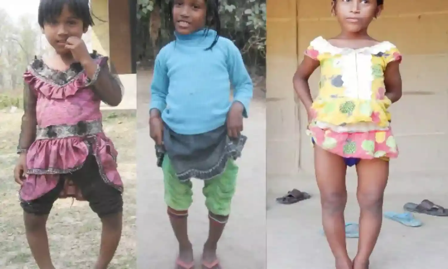 Fluoride Contamination Cripples More Than 1,000 Children In Assam