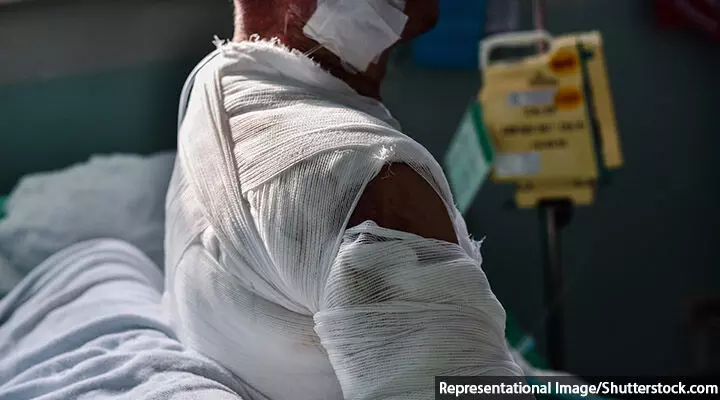 India’s Burn-Care Management Suffers From Lack Of Data, Beds, Trained Medics