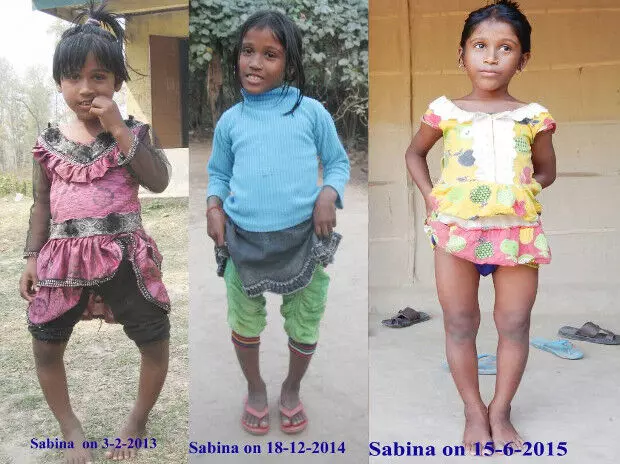 Fluoride Contamination Cripples More Than 1,000 Children In Assam