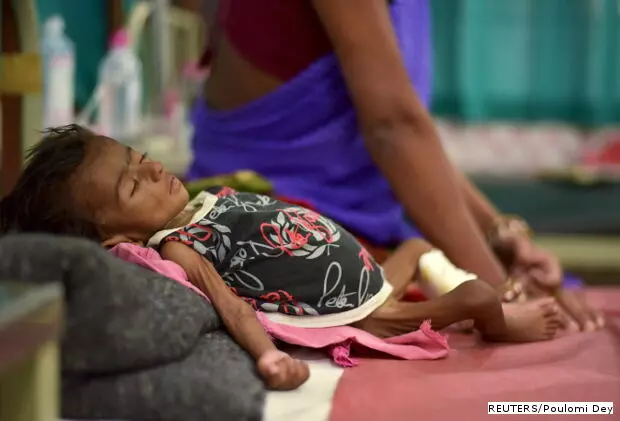 Why Malnutrition Remains A Challenge For India