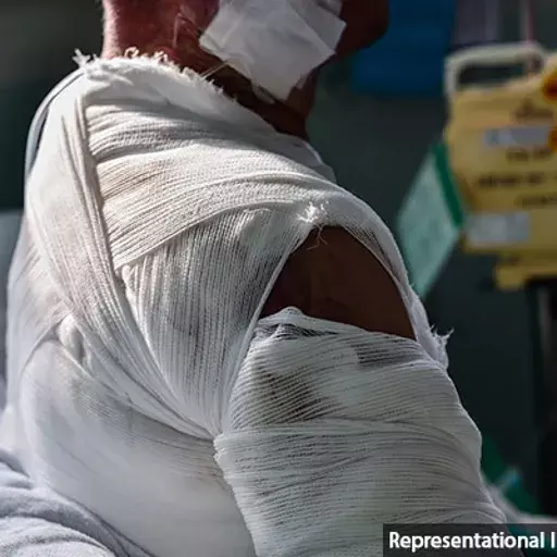 India’s Burn-Care Management Suffers From Lack Of Data, Beds, Trained Medics India’s Burn-Care Management Suffers From Lack Of Data, Beds, Trained Medics