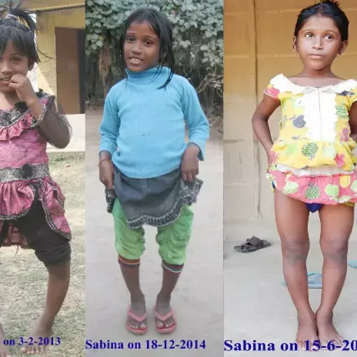 Fluoride Contamination Cripples More Than 1,000 Children In Assam