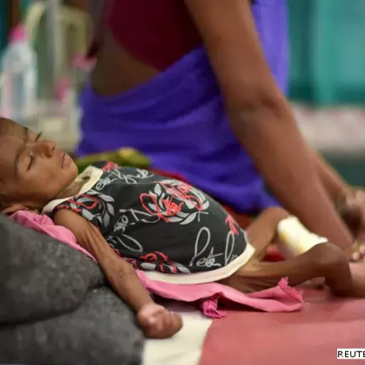 Why Malnutrition Remains A Challenge For India Why Malnutrition Remains A Challenge For India