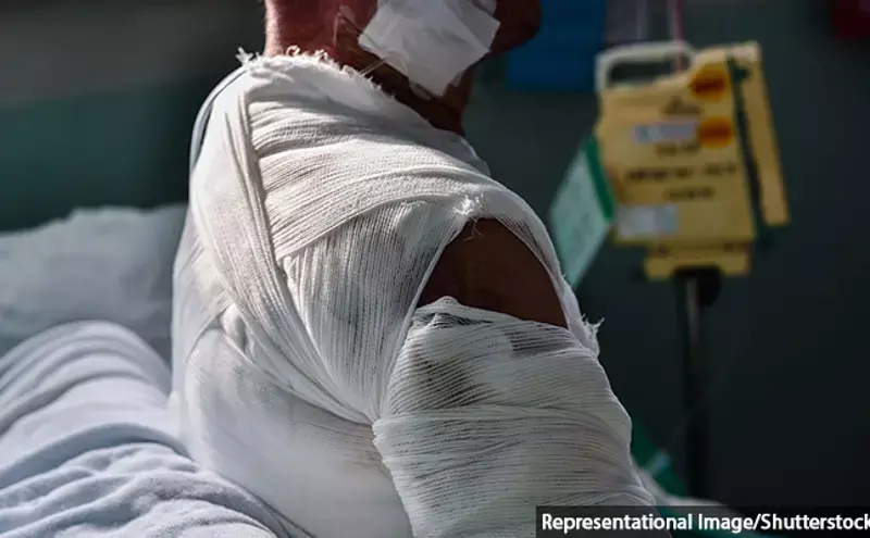 India’s Burn-Care Management Suffers From Lack Of Data, Beds, Trained Medics India’s Burn-Care Management Suffers From Lack Of Data, Beds, Trained Medics